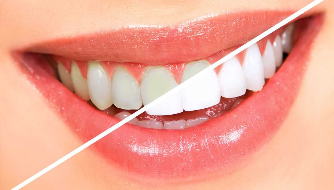 san-jose-teeth-whitening
