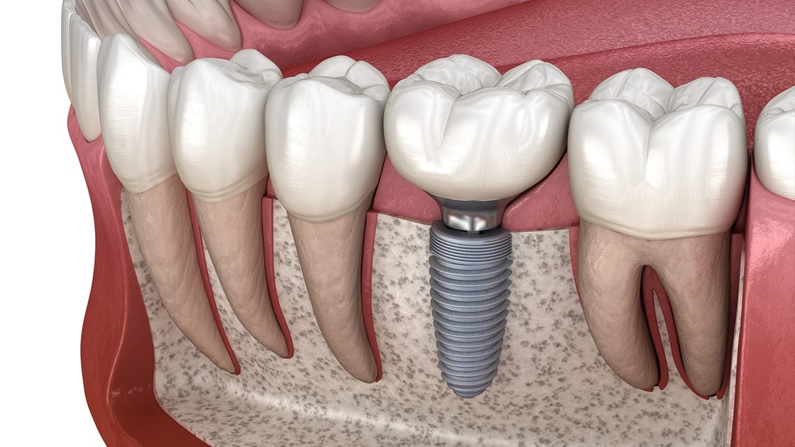Unlocking the Power of Dental Implants